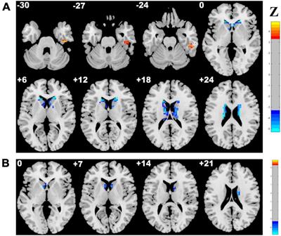 Abnormal whole-brain voxelwise structure-function coupling and its association with cognitive dysfunction in patients with different cerebral small vessel disease burdens